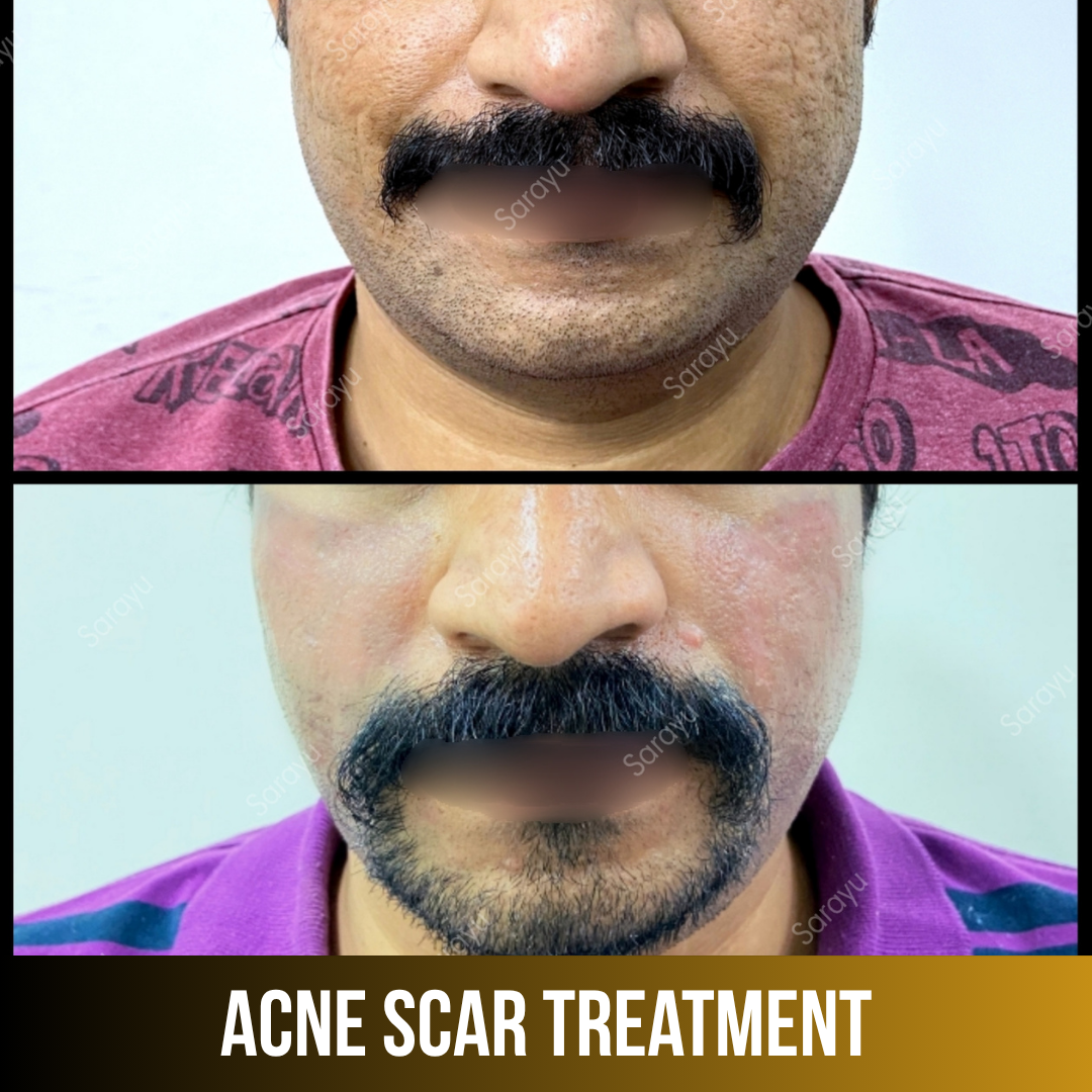 Patient receiving acne scar treatment at Sarayu Clinics in Delhi to reduce acne scars, improve skin texture, and achieve smoother, clearer skin.