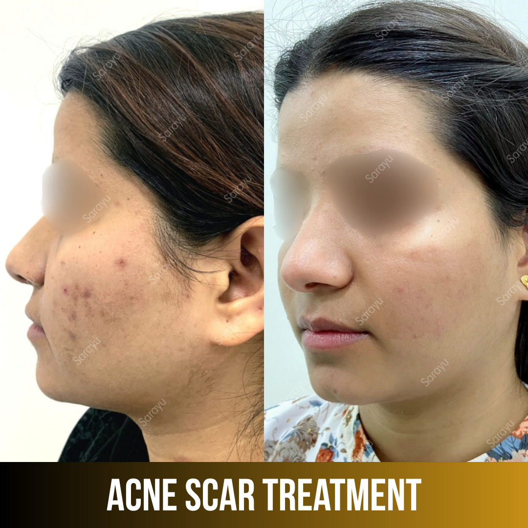 Sarayu Clinics offers acne scar treatment in Delhi using advanced laser therapy, microneedling, and collagen-stimulating techniques to reduce acne scars, improve skin texture, and restore smoother, clearer, and naturally radiant skin with safe, effective, and non-surgical results.