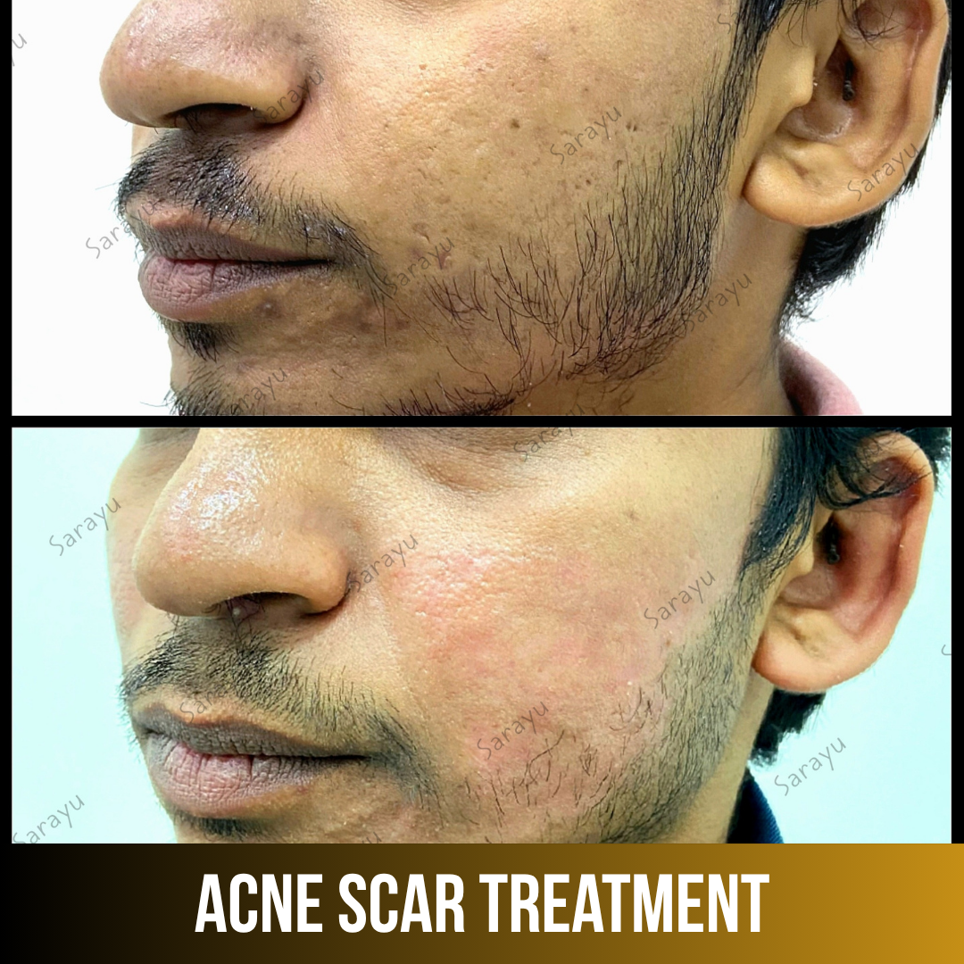 Patient receiving acne scar treatment at Sarayu Clinics in Delhi to reduce acne scars, improve skin texture, and achieve smoother, clearer skin.