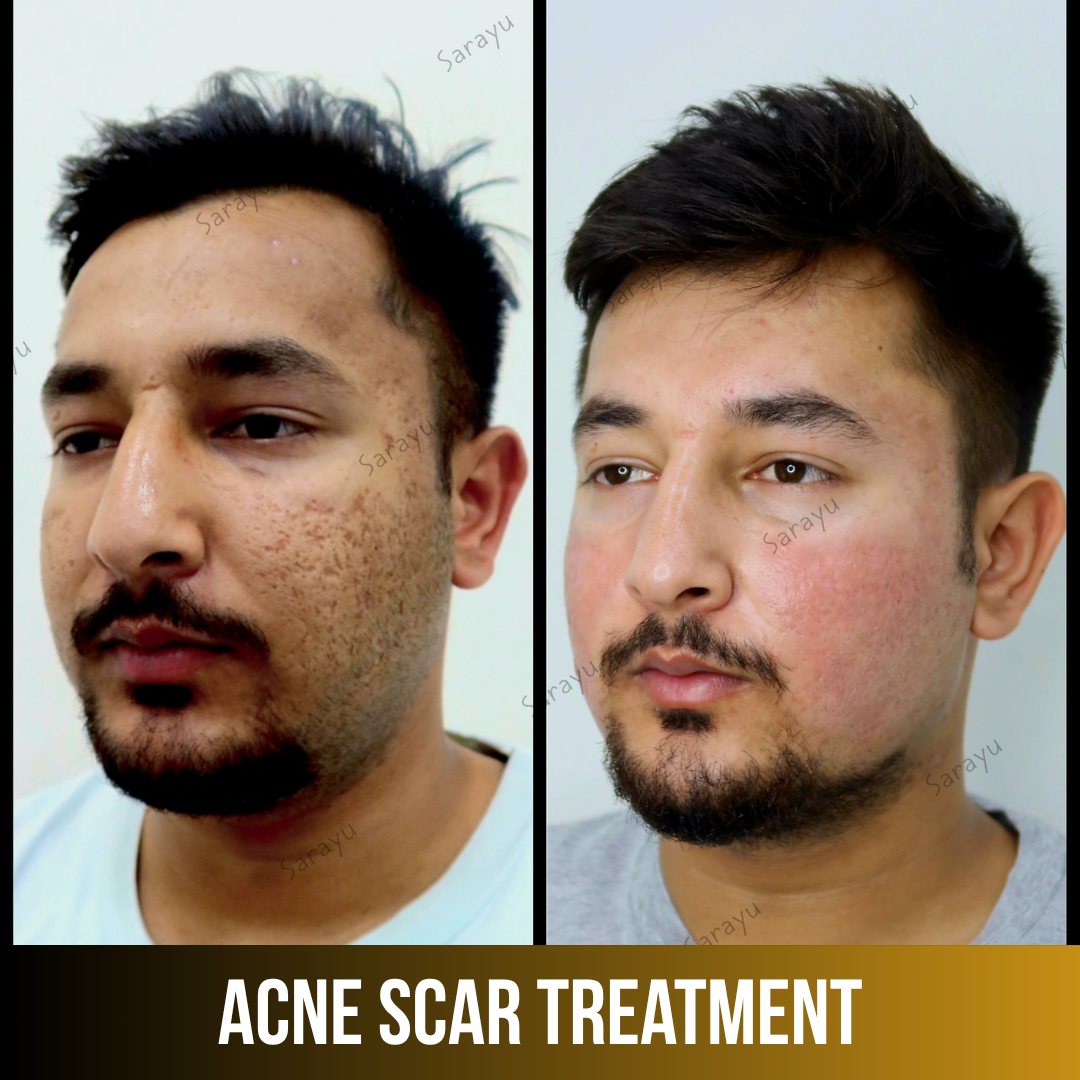 Patient receiving acne scar treatment at Sarayu Clinics in Delhi to reduce acne scars, improve skin texture, and achieve smoother, clearer skin.