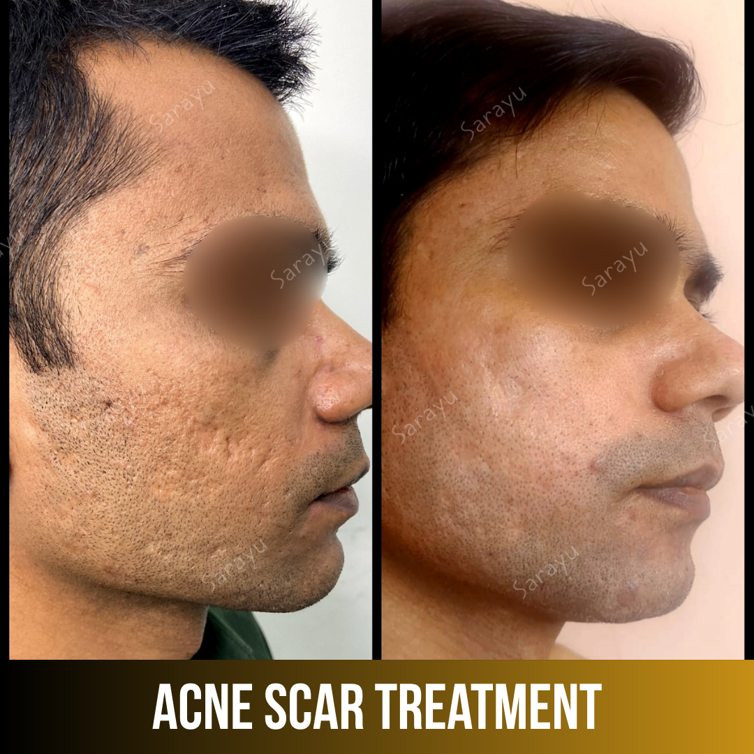 Patient receiving acne scar treatment at Sarayu Clinics in Delhi to reduce acne scars, improve skin texture, and achieve smoother, clearer skin.