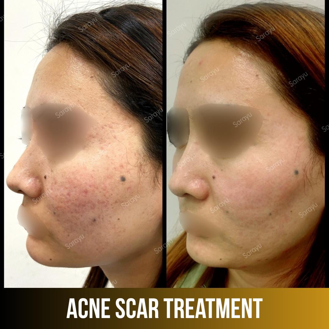 Patient receiving acne scar treatment at Sarayu Clinics in Delhi to reduce acne scars, improve skin texture, and achieve smoother, clearer skin.