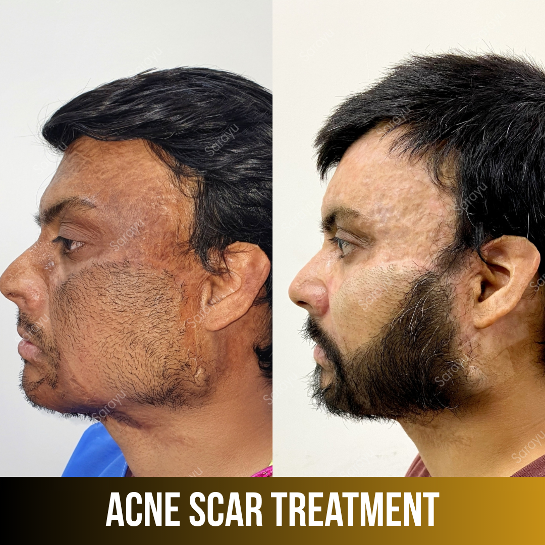 Patient receiving acne scar treatment at Sarayu Clinics in Delhi to reduce acne scars, improve skin texture, and achieve smoother, clearer skin.