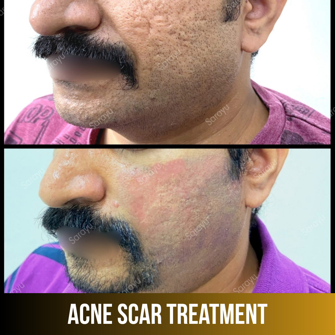 Sarayu Clinics offers acne scar treatment in Delhi using advanced laser therapy, microneedling, and collagen-stimulating techniques to reduce acne scars, improve skin texture, and restore smoother, clearer, and naturally radiant skin with safe, effective, and non-surgical results.