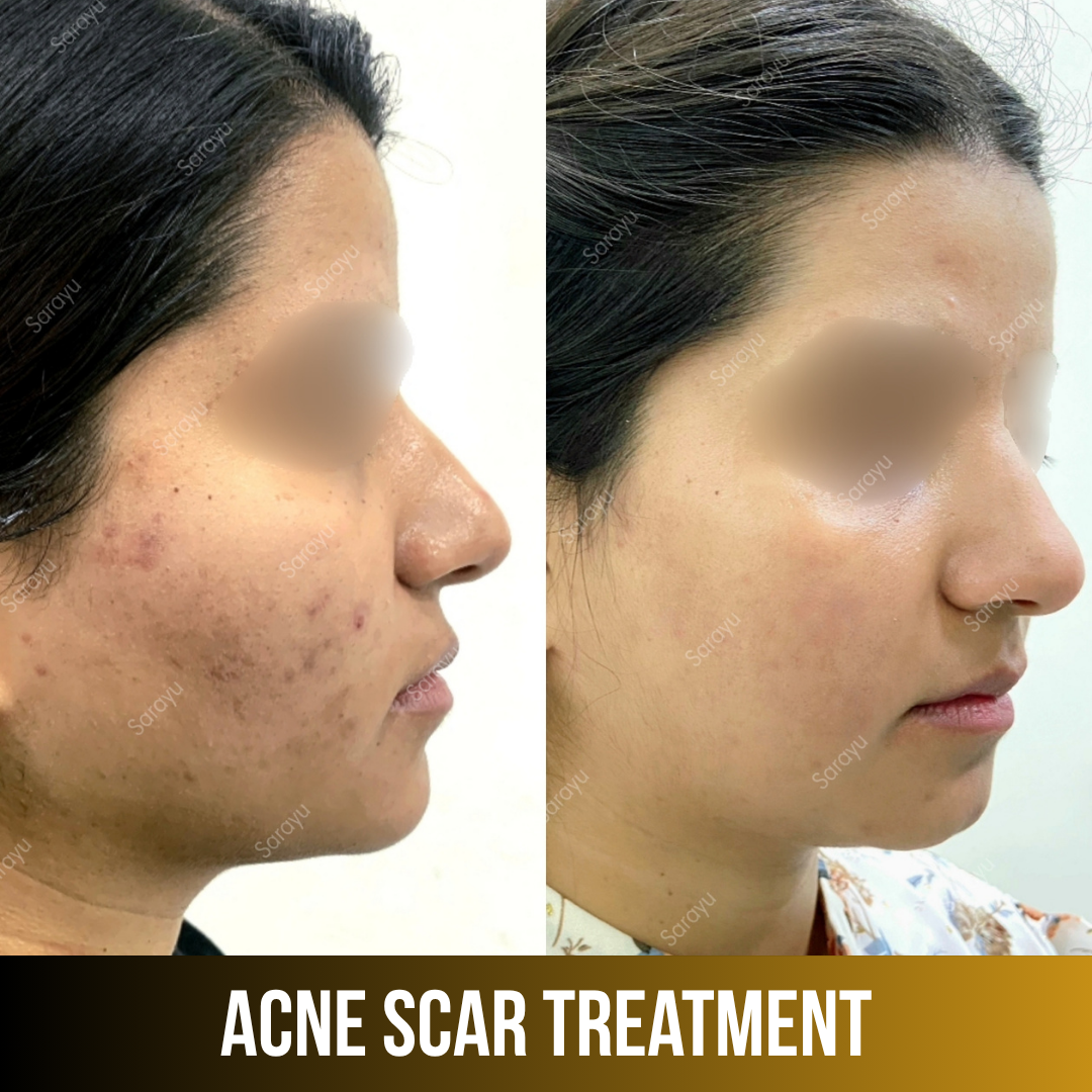 Sarayu Clinics offers acne scar treatment in Delhi using advanced laser therapy, microneedling, and collagen-stimulating techniques to reduce acne scars, improve skin texture, and restore smoother, clearer, and naturally radiant skin with safe, effective, and non-surgical results.