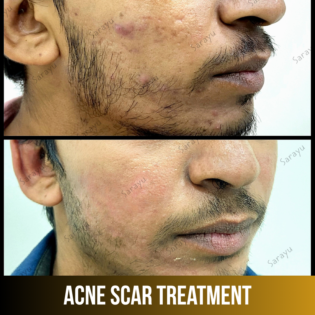 Patient receiving acne scar treatment at Sarayu Clinics in Delhi to reduce acne scars, improve skin texture, and achieve smoother, clearer skin.