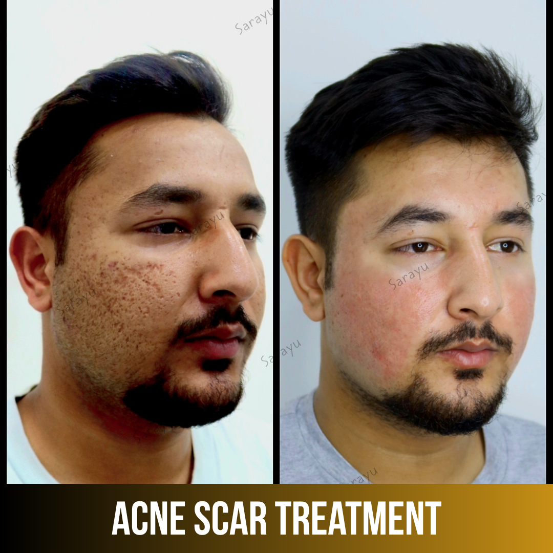 Patient receiving acne scar treatment at Sarayu Clinics in Delhi to reduce acne scars, improve skin texture, and achieve smoother, clearer skin.