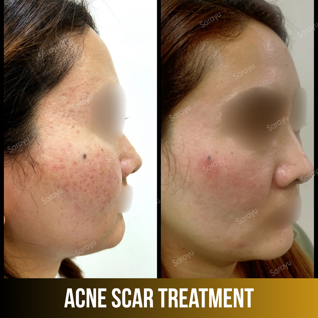 Patient receiving acne scar treatment at Sarayu Clinics in Delhi to reduce acne scars, improve skin texture, and achieve smoother, clearer skin.