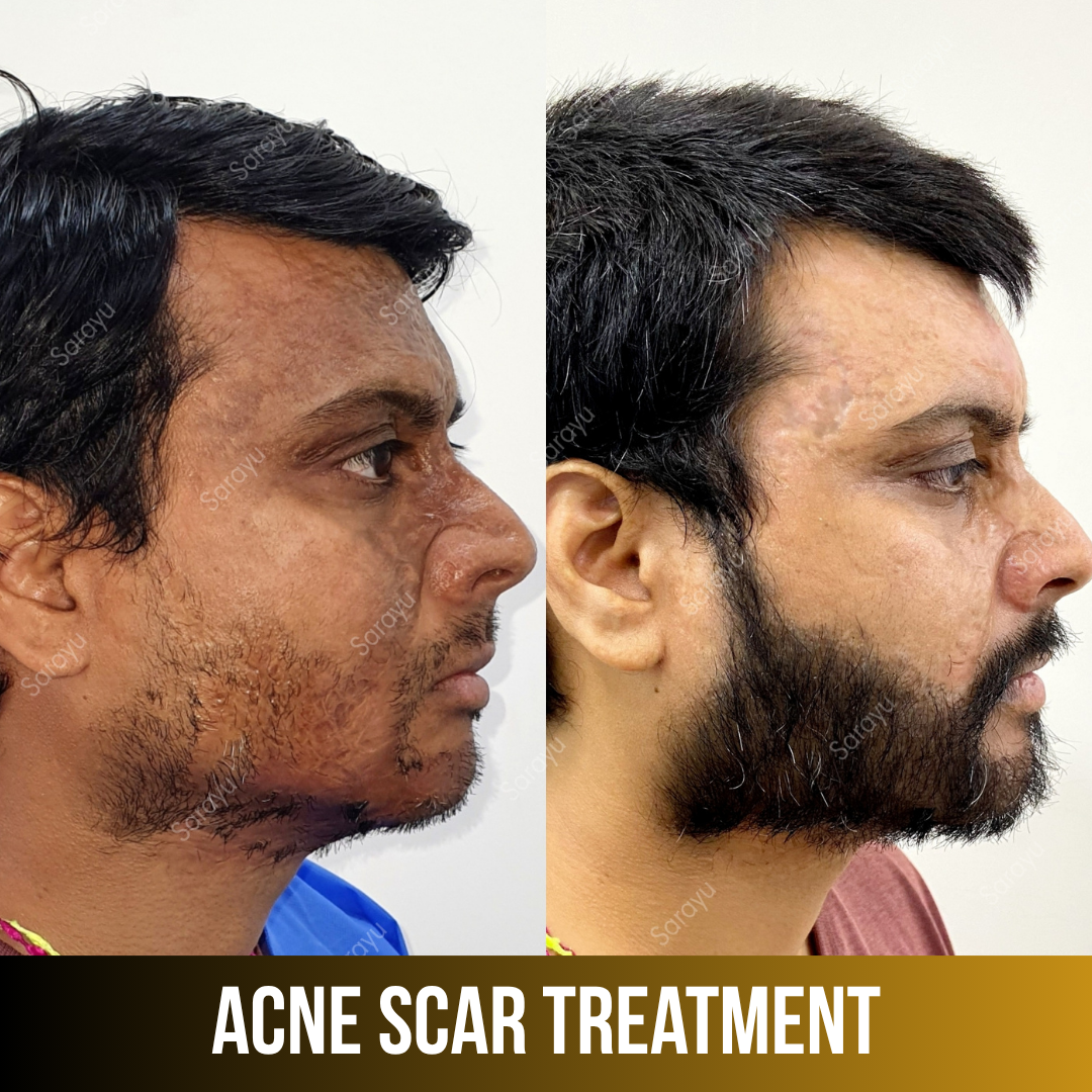 Patient receiving acne scar treatment at Sarayu Clinics in Delhi to reduce acne scars, improve skin texture, and achieve smoother, clearer skin.
