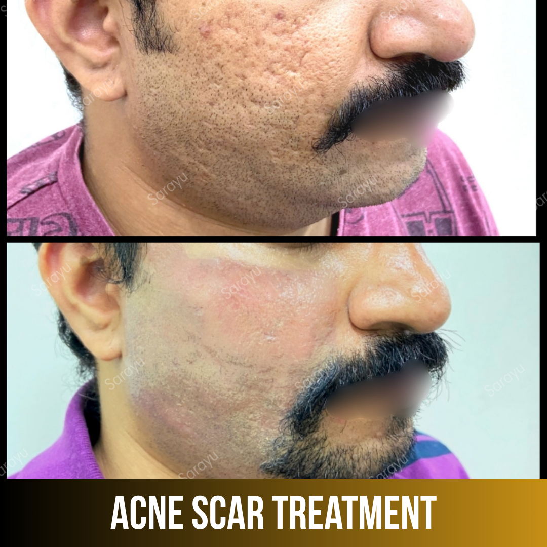 Sarayu Clinics offers acne scar treatment in Delhi using advanced laser therapy, microneedling, and collagen-stimulating techniques to reduce acne scars, improve skin texture, and restore smoother, clearer, and naturally radiant skin with safe, effective, and non-surgical results.