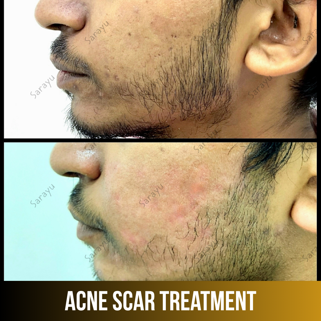 Patient receiving acne scar treatment at Sarayu Clinics in Delhi to reduce acne scars, improve skin texture, and achieve smoother, clearer skin.