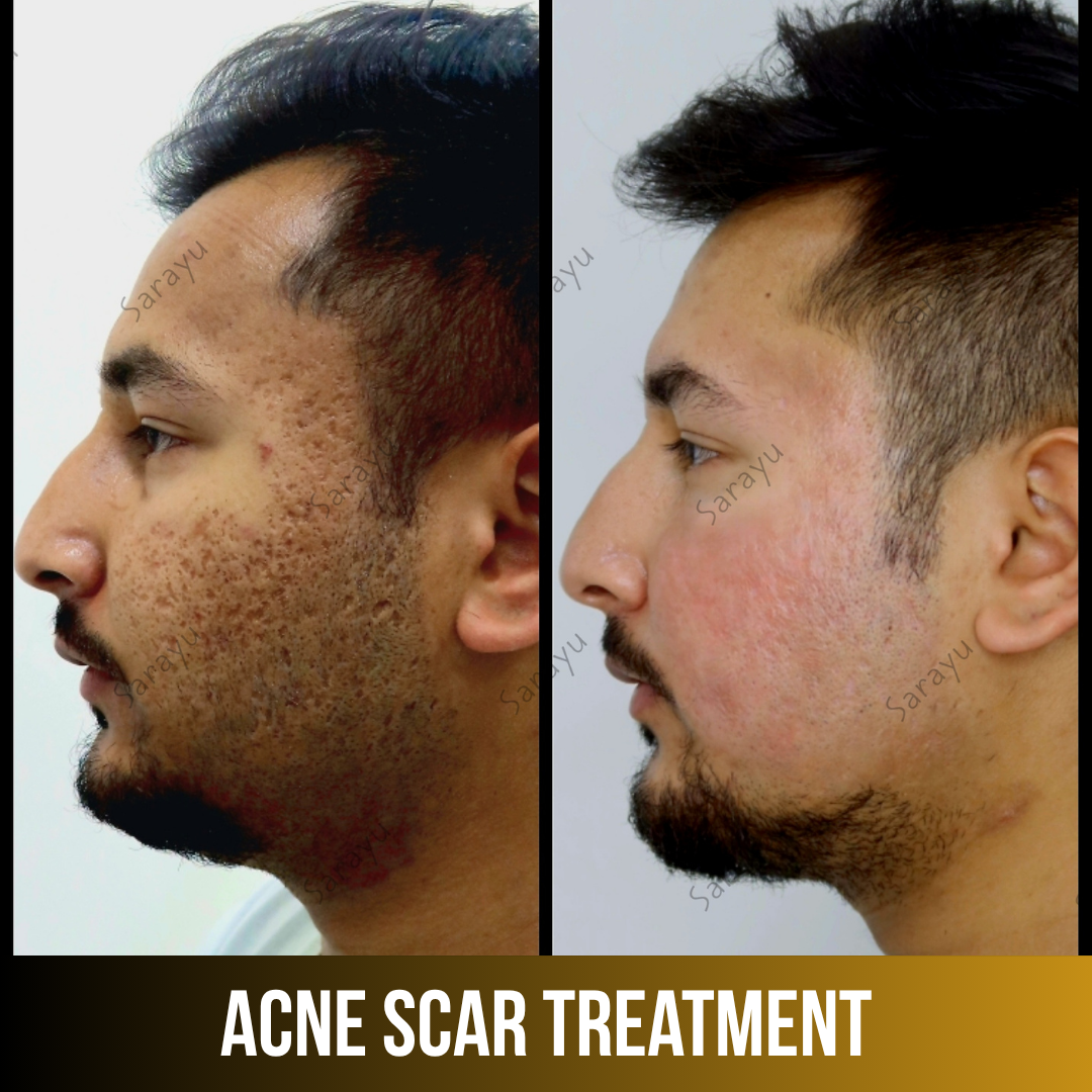 Patient receiving acne scar treatment at Sarayu Clinics in Delhi to reduce acne scars, improve skin texture, and achieve smoother, clearer skin.