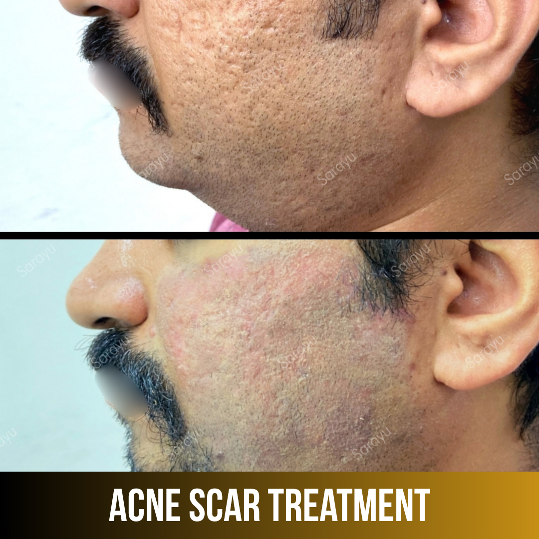 Sarayu Clinics offers acne scar treatment in Delhi using advanced laser therapy, microneedling, and collagen-stimulating techniques to reduce acne scars, improve skin texture, and restore smoother, clearer, and naturally radiant skin with safe, effective, and non-surgical results.