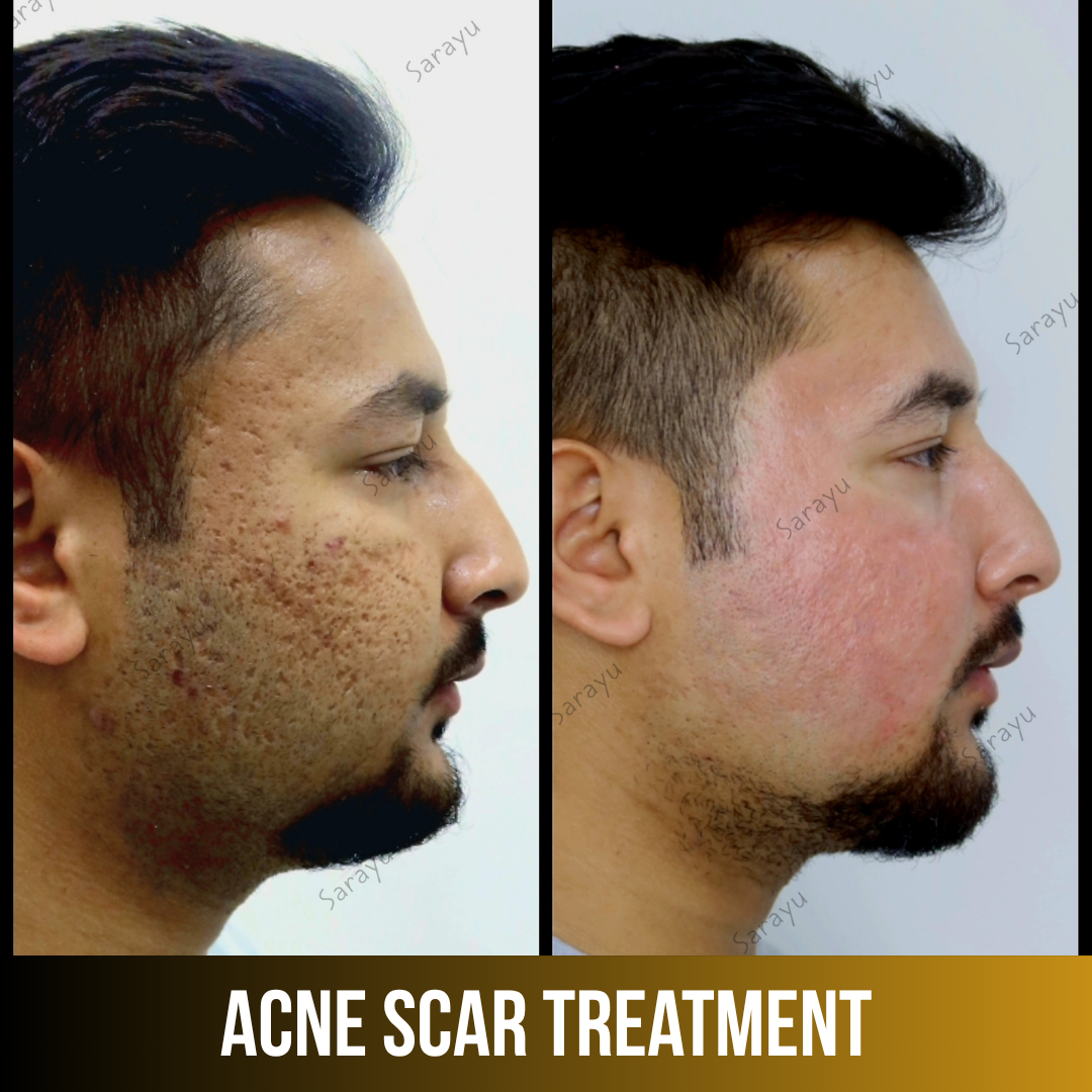 Patient receiving acne scar treatment at Sarayu Clinics in Delhi to reduce acne scars, improve skin texture, and achieve smoother, clearer skin.