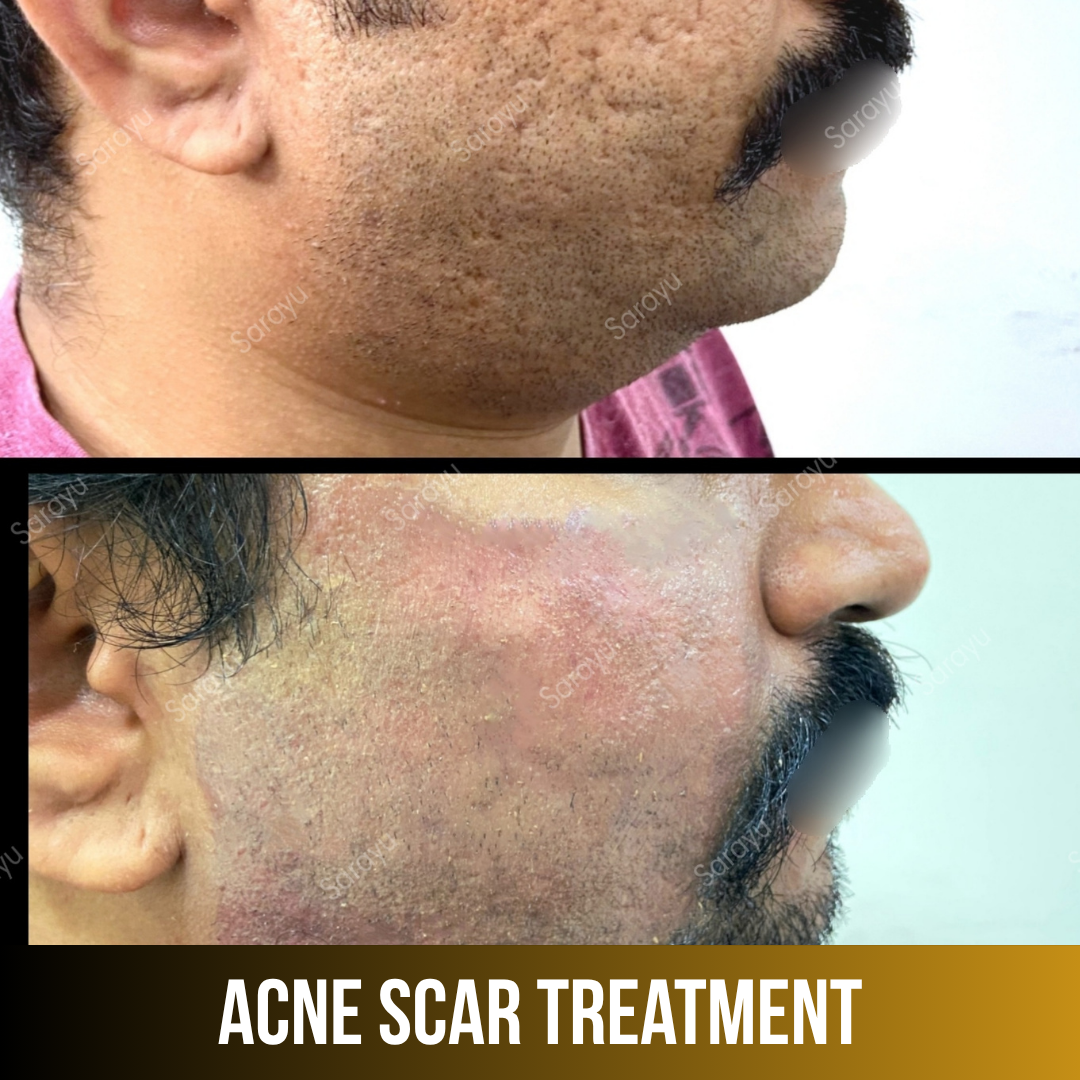 Sarayu Clinics offers acne scar treatment in Delhi using advanced laser therapy, microneedling, and collagen-stimulating techniques to reduce acne scars, improve skin texture, and restore smoother, clearer, and naturally radiant skin with safe, effective, and non-surgical results.
