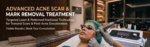 Patient undergoing advanced acne scar and acne mark removal treatment using fractional laser technology at a dermatology clinic for post-acne pigmentation and atrophic scars.