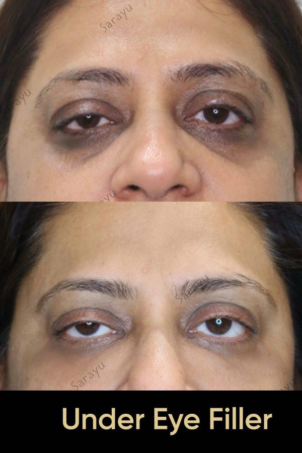 Close-up of a person's face with improved under-eye area smoothness and reduced appearance of dark circles/puffiness.