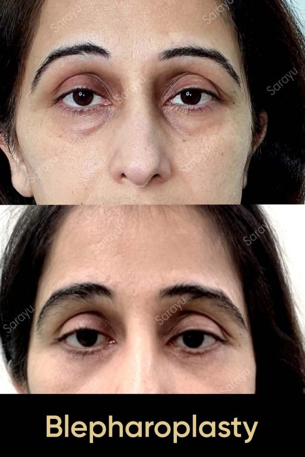 Close-up of a person with refreshed eyes exhibiting smoother skin and reduced signs of aging around the eyelids after Blepharoplasty Surgery in Delhi
