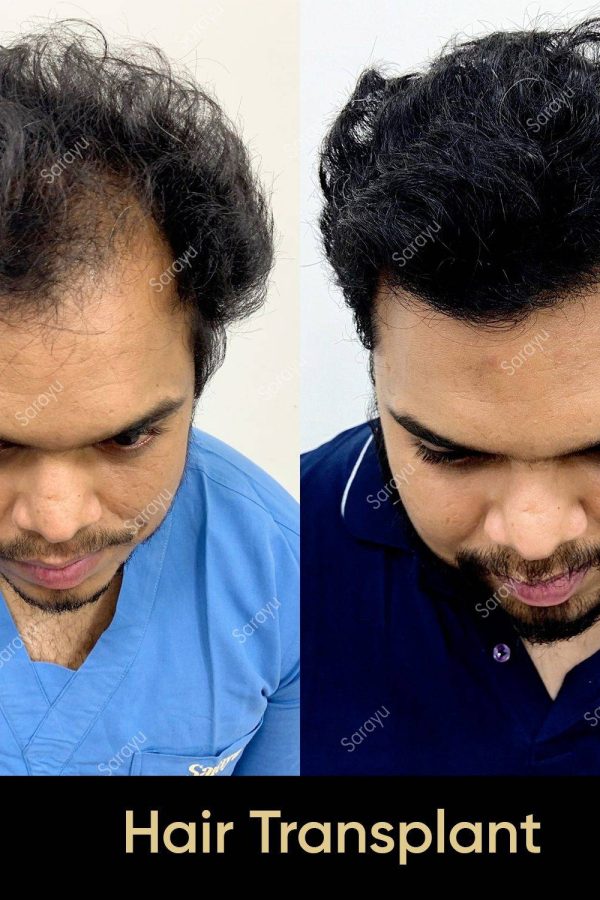 Close-up of healthy scalp with restored hair after a hair transplant procedure in Delhi.