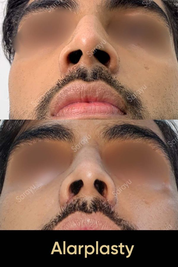 Close-up of a face with a slightly refined nose profile after Alarplasty Surgery in Delhi