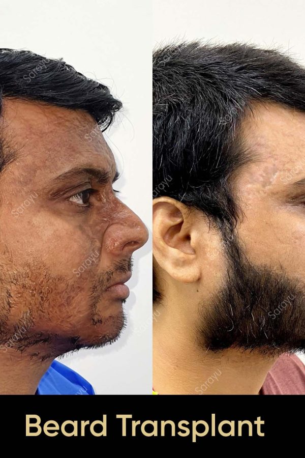 Close-up of a face with a full, natural-looking beard after Beard Hair Transplant Surgery