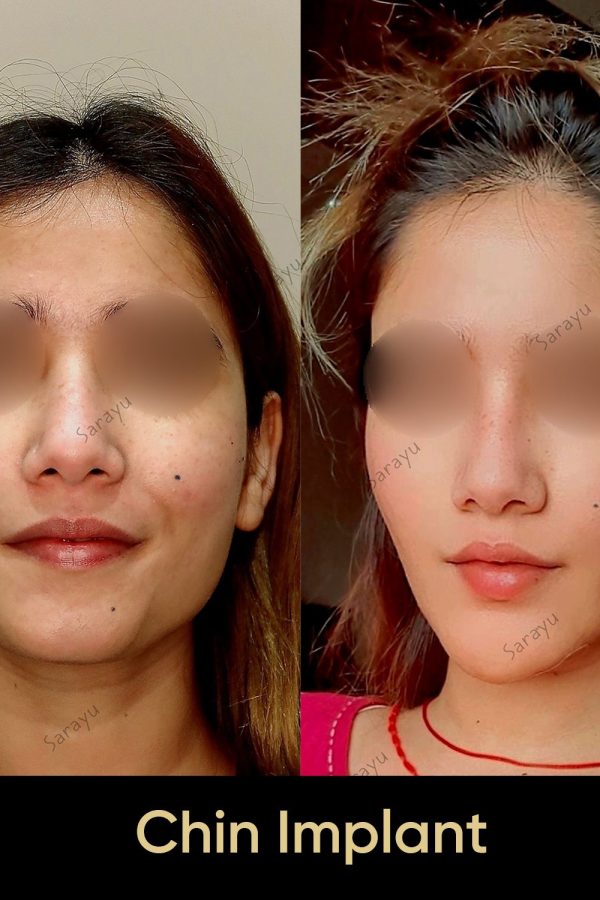 Close-up of a face with a balanced and defined jawline after chin implant surgery in Delhi