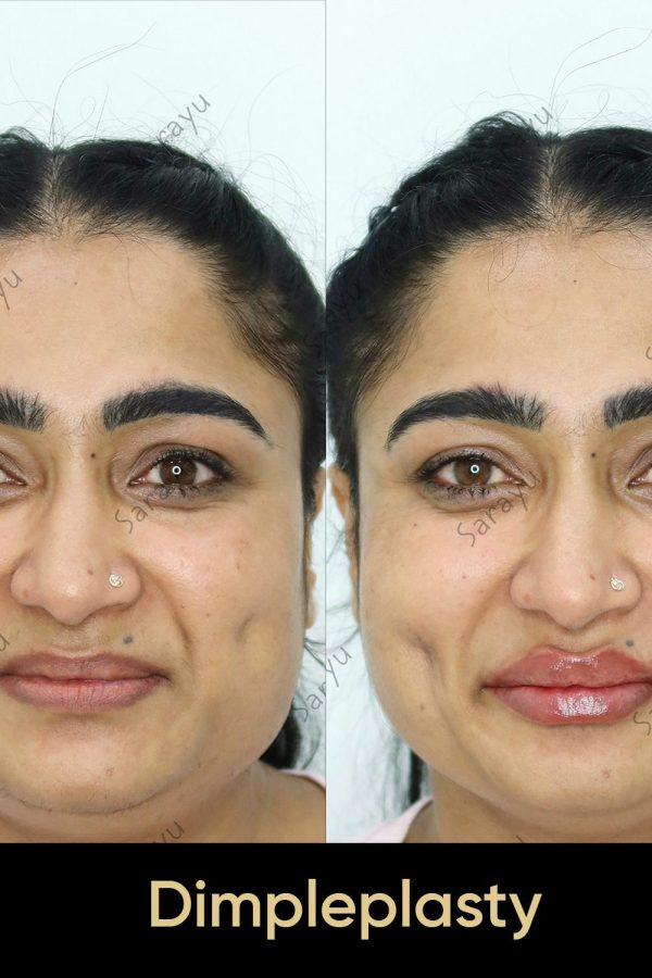 Close-up of a person's face with balanced and natural-looking features after Dimpleplasty procedure in Delhi