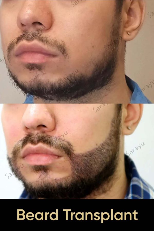 Close-up of a face with a full, natural-looking beard after Beard Hair Transplant Surgery