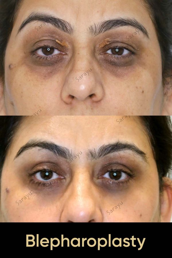 Close-up of a person with refreshed eyes exhibiting smoother skin and reduced signs of aging around the eyelids after Blepharoplasty Surgery in Delhi