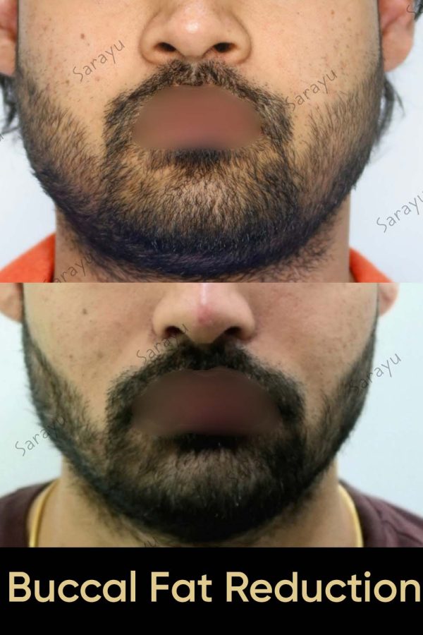 Close-up of a face with a more defined jawline and balanced features after Buccal Fat Reduction