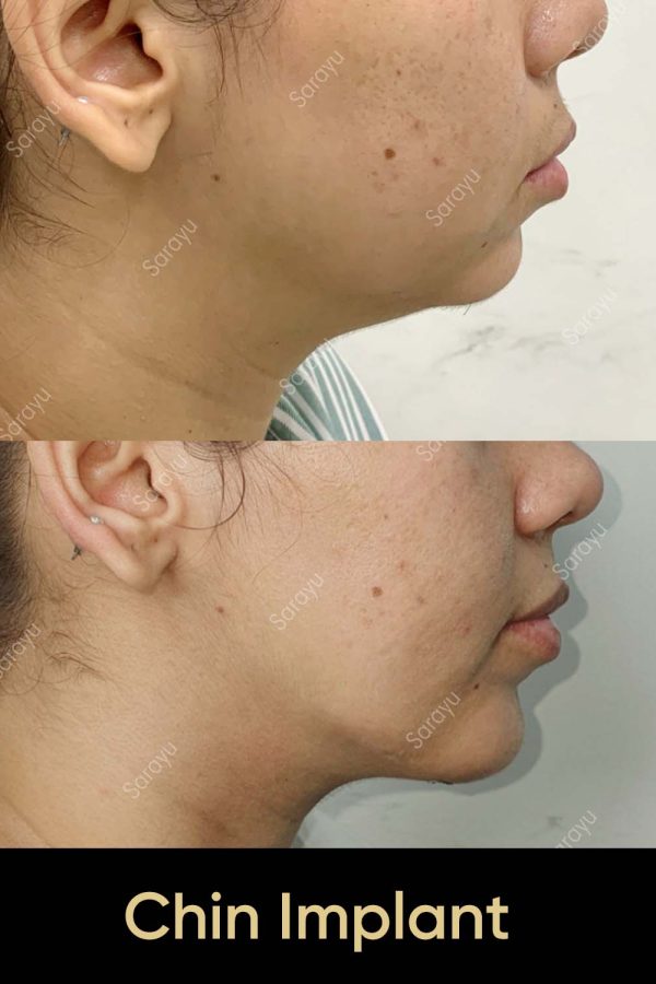 Close-up of a face with a balanced and defined jawline after chin implant surgery in Delhi