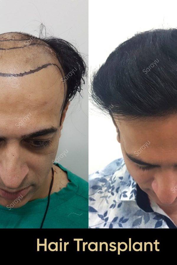Close-up of healthy scalp with restored hair after a hair transplant procedure in Delhi.