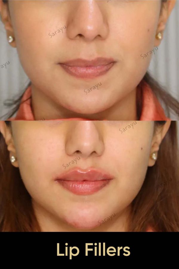 Close-up of a person with balanced, natural-looking lips.