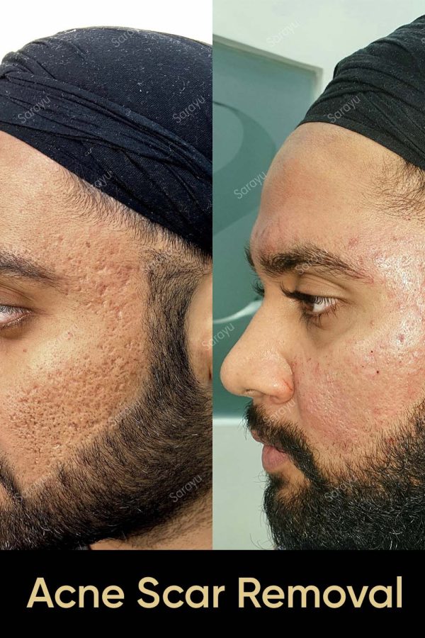 Close-up of a person with improved skin texture and reduced acne scars after Acne Scar Removal Treatment in Delhi