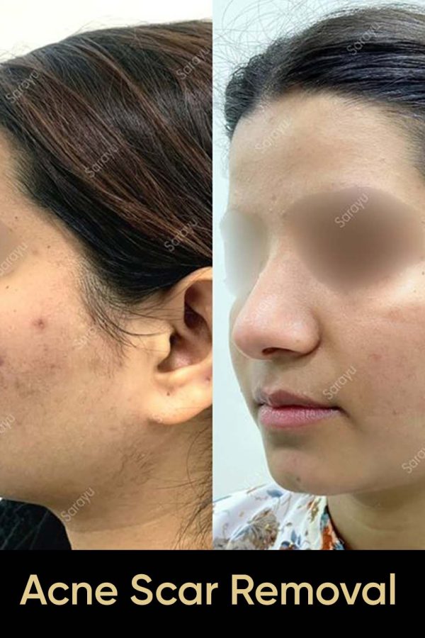 Close-up of a person with improved skin texture and reduced acne scars after Acne Scar Removal Treatment in Delhi