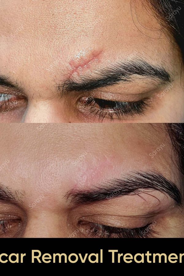 Close-up of healed skin showcasing improvement in the appearance of a scar.