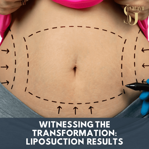 See the dramatic difference liposuction can make! These before and after photos demonstrate the remarkable body sculpting outcomes achievable at Sarayu Clinics.