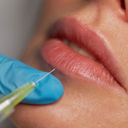 Patient receiving lip fillers in Delhi at Sarayu Clinics, administered by Dr. Adarsh Tripathi for fuller, more defined lips. Lip fillers in delhi price Top 10 lip fillers in delhi Best lip fillers in delhi Cheapest lip fillers in delhi Permanent lip fillers cost Permanent lip filler cost in India Lip fillers cost India